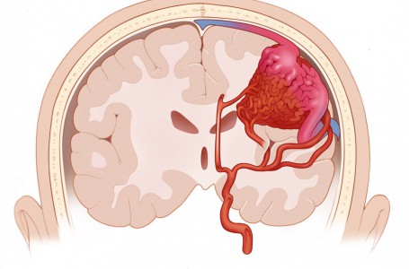 Arteriovenózní malformace Arteriovenózní malformace