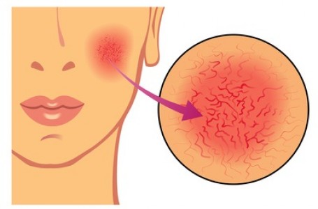 Růžovka, odborně rosacea, je velmi časté zánětlivé kožní onemocnění obličeje. Růžovka, odborně rosacea, je velmi časté zánětlivé kožní onemocnění obličeje.