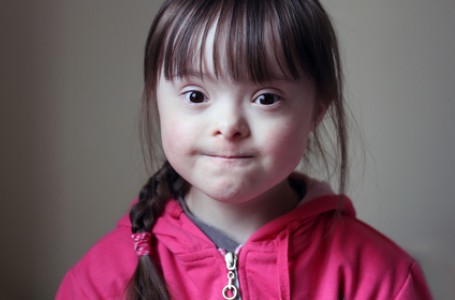 Základem onemocnění Downovým syndromem je chromozomální vada. Základem onemocnění Downovým syndromem je chromozomální vada.