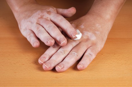 Vitiligo Vitiligo