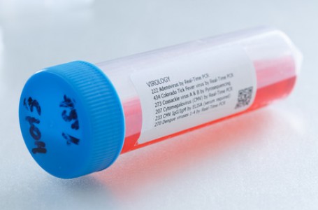 Cytomegalovirová infekce Cytomegalovirová infekce