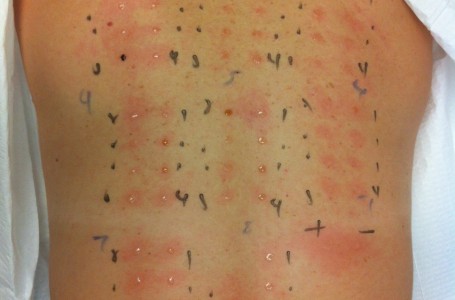kožní testpři alergii kožní testpři alergii