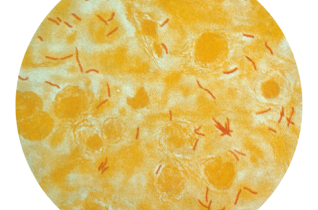Mycobacterium tuberculosis, zdroj foto: Wikipedia Mycobacterium tuberculosis, zdroj foto: Wikipedia