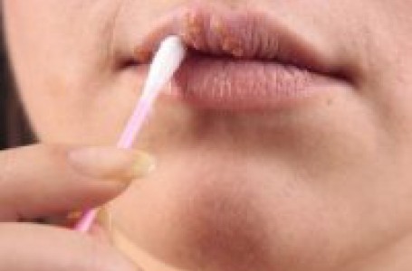 Jestliže již puchýřky na rtu zasychají, podávání antivirotik nemá význam. Jestliže již puchýřky na rtu zasychají, podávání antivirotik nemá význam.
