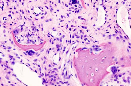 Primární osteoartróza kolenního kloubu, zdroj foto: Wikipedia Primární osteoartróza kolenního kloubu, zdroj foto: Wikipedia