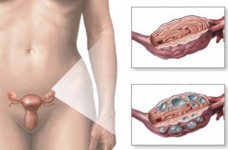 Syndrom polycystických ovarií Syndrom polycystických ovarií