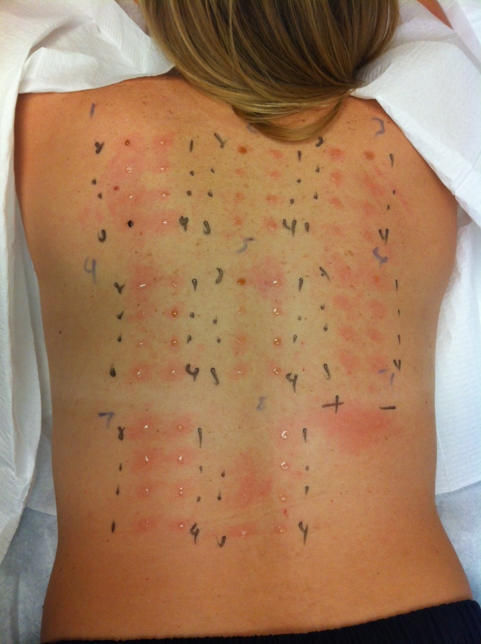 my-back-during-the-food-allergy-test-the-allergy-test-968x1296