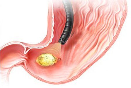 Endoskopické vyšetření žaludku je běžnou metodou diagnostiky žaludečních vředů. 